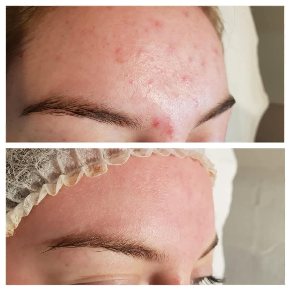 Front avec imperfections avant, puis peau apaisée après les séances