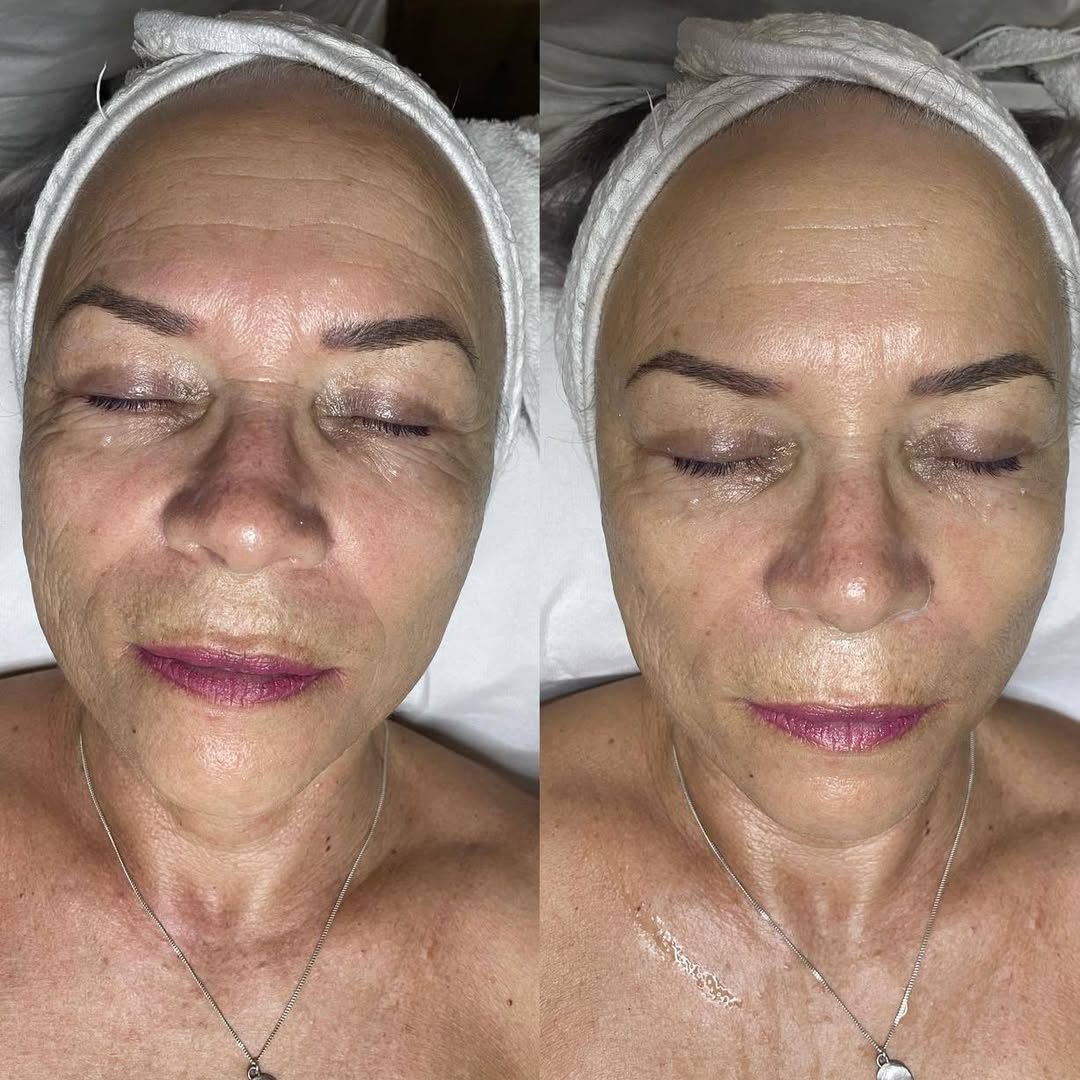 Visage de face avant et après soin, peau plus ferme